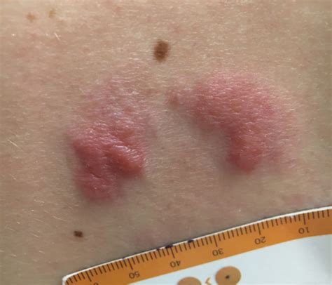 Grouped Erythematous Papules and Plaques on the Trunk | MDedge Dermatology