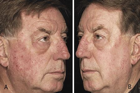 Actinic Keratosis: Diagnosis and treatment - Dermatologist in Santa Rosa, CA | NorCal Dermatology