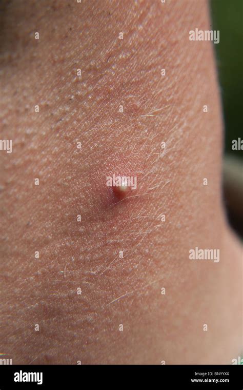 Large acne spot or pimple on a mans neck Stock Photo - Alamy