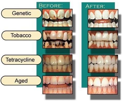 Tooth Discoloration /Smiles on Bristol Dentistry - Smiles On Bristol Dentistry