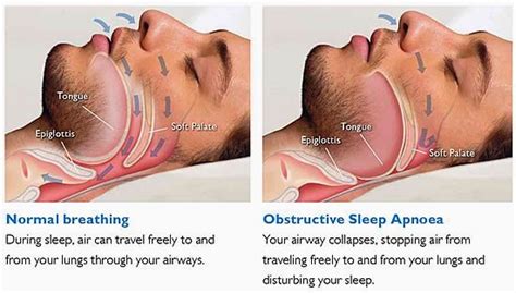 Sleep Apnea - Avenue Dental