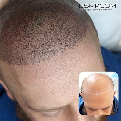 Best Scalp Micropigmentation Near Me In 2024