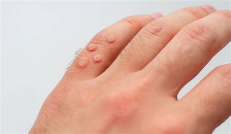 We Explain How Do Dermatologists Remove Warts | DCSI