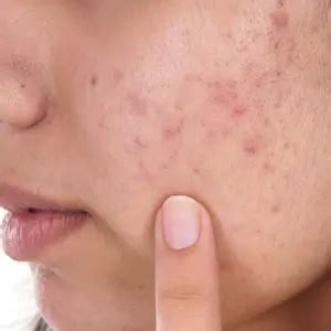 Diagnosis And Treatment Of Acne Scars | Schweiger Dermatology Group