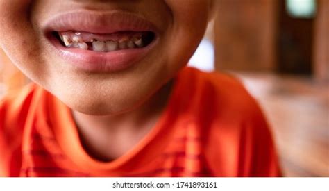 16 Baby Bottle Tooth Decay Images, Stock Photos & Vectors | Shutterstock