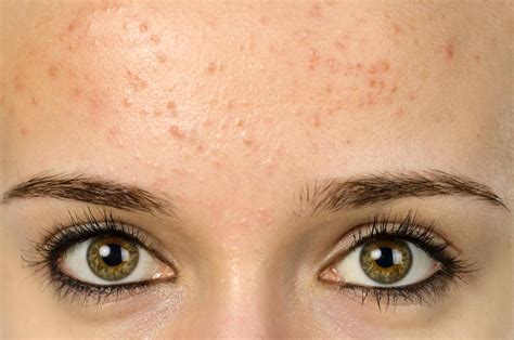 How To Get Rid Of Acne On Your Forehead - Fitness Pamphlet