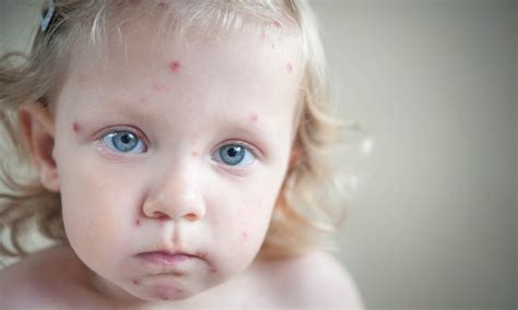 Staph Infection In Babies Pictures - PictureMeta