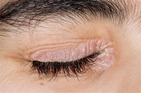 Psoriasis on the eyelids symptoms causes and treatment – Artofit