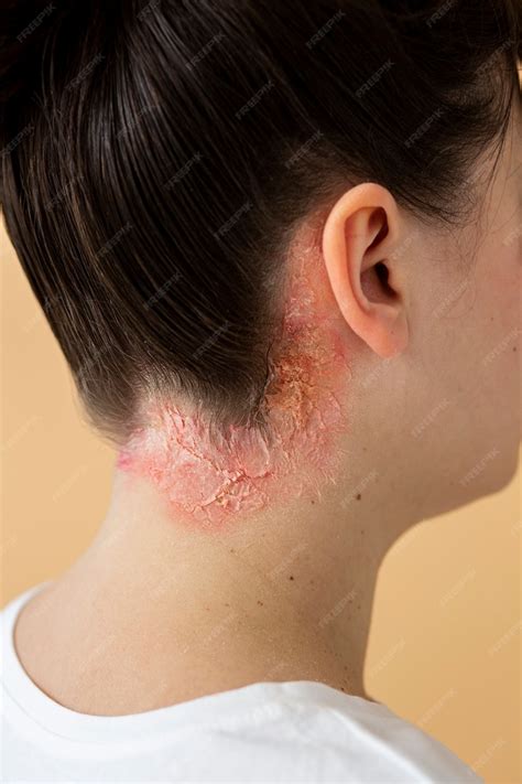 Free Photo | Psoriasis eczema on neck of patient