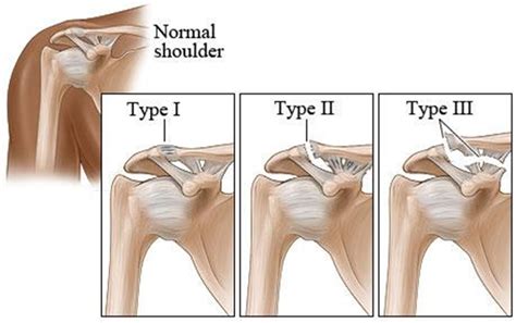 What is AC joint separation? Do I need surgery for this?