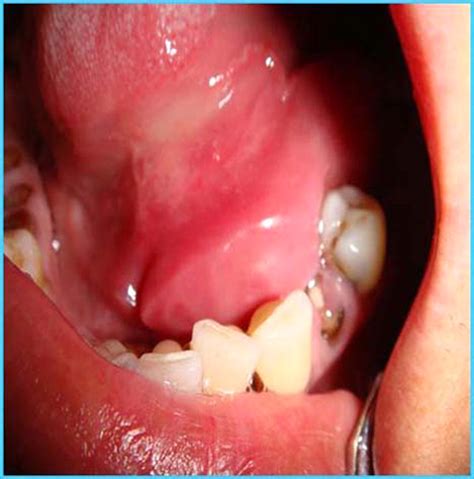 Sublingual Gland Cancer