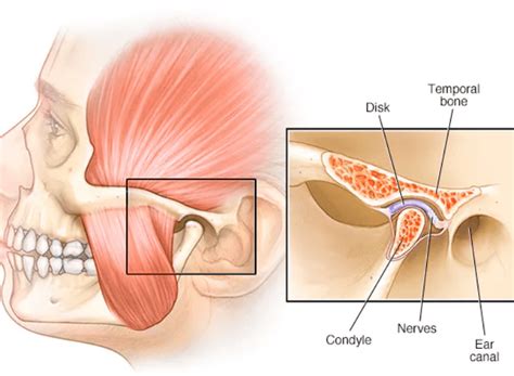 TMJ Disorder - Maxillofacial