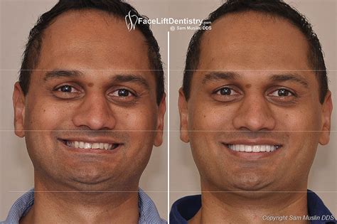 Before And After Overjet Profile