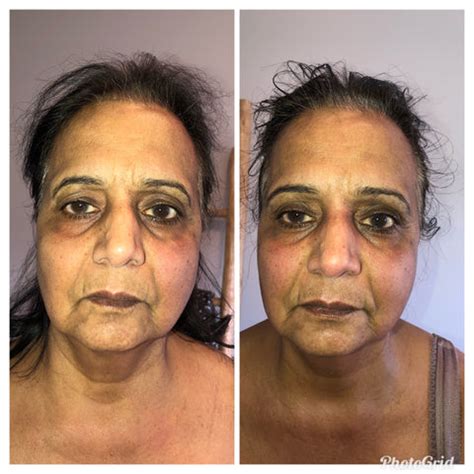 Before&After – FACEFIT CANADA