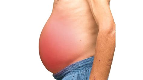 Ascites: Facts & Treatments