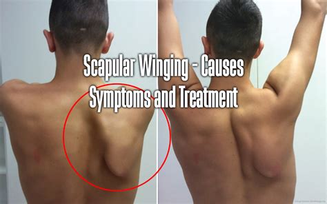 Scapular Winging - Causes Symptoms and Treatment