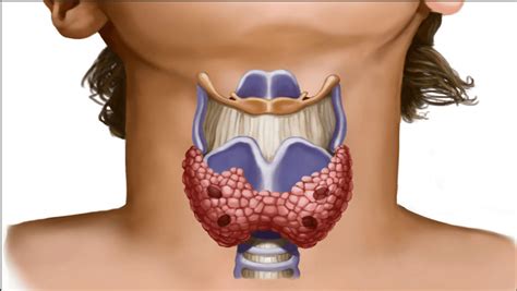 Diffuse toxic goiter