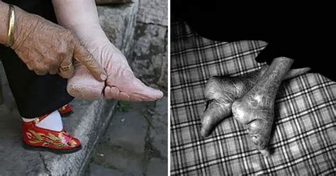 These Are The “Lotus Feet” Of The Last Women In China Who Practise Foot Binding – Pulptastic