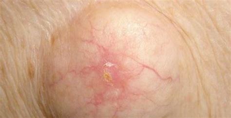 Armpit Cyst, Causes, Painful, Symptoms, Removal & Treatment