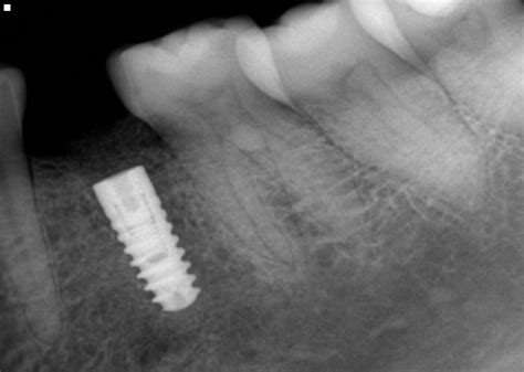 Dental Case Study: Immediate Extraction and Implant Placement Tooth Non ...