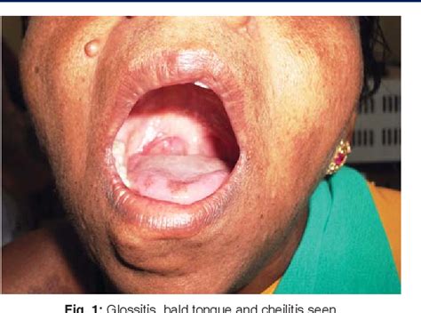 A Case of Plummer-Vinson Syndrome Esophageal Web Dysphagia treated by Dilatation with Cuffed ...