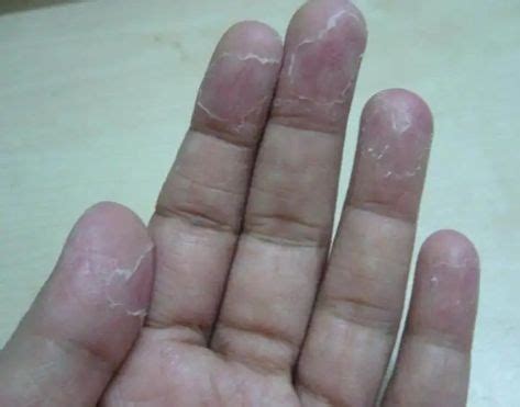 Skin peeling on fingers may be one of the most perplexing, let alone uncomfortable, strange skin ...