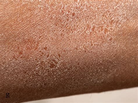 Ashy Skin: Causes, Solutions, & Home Remedies To Try – glooshi.