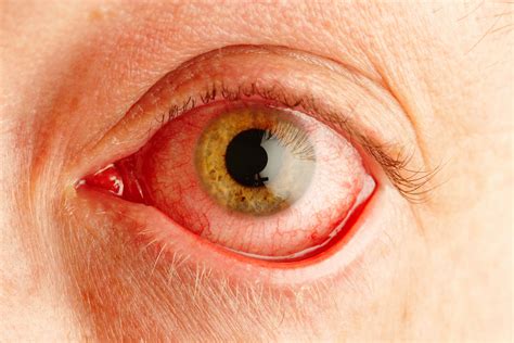 Covid symptoms - sore, itchy eyes could be early coronavirus warning ...