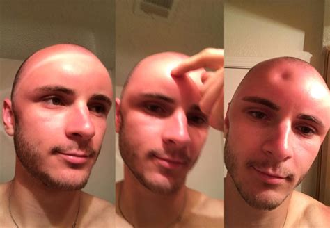 Severe sunburn leaves man's head swollen