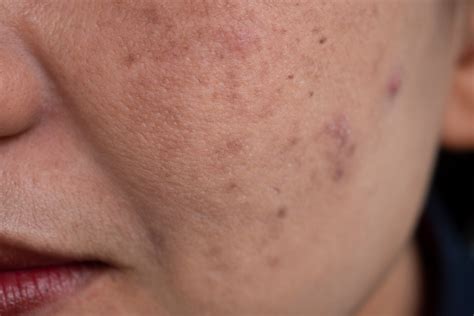 Melasma Treatment | Epiphany Dermatology