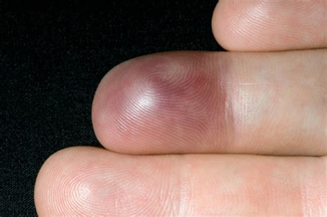 An unusual finger injury | The BMJ