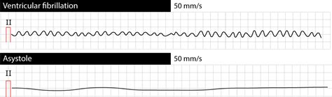 Ventricular fibrillation, pulseless electrical activity and sudden cardiac arrest – ECG & ECHO