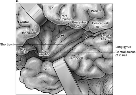 Image result for sylvian fissure | Medicine illustration, Med school, Image