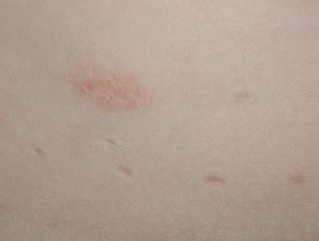 Molluscum contagiosum - Dermatly.com - Ihre Hautseite