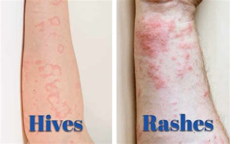 Rash Vs. Hives: How To Identify And Treat Them Naturally