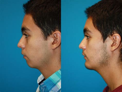 Chin Augmentation in Charleston, SC | Chin Surgery | Near Me