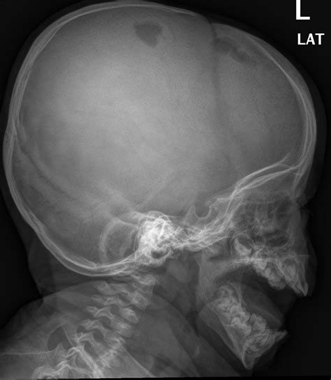 Langerhans cell histiocytosis chest x ray - wikidoc