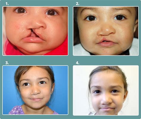 Surgical Management Cleft Lip And Palate - vrogue.co