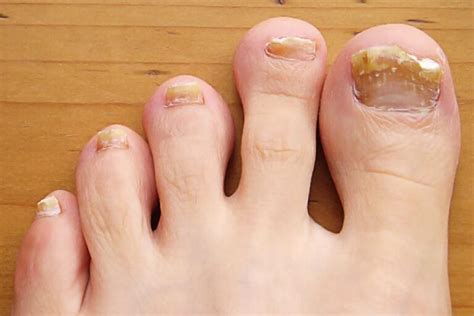 Thick Toenails – Symptoms, Diagnosis and Treatment – Da Vinci Foot & Ankle
