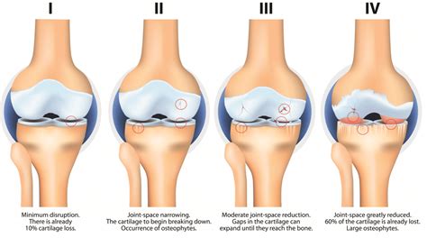 Osteoarthritis Stages Knee