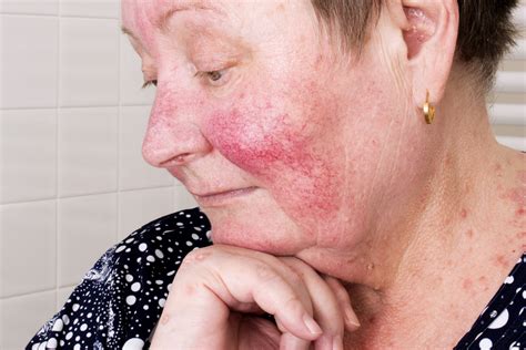 Elderly woman with rosacea, facial skin disorder - Knoxville ...