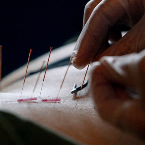 Medicare proposal would cover acupuncture for lower back pain | STAT
