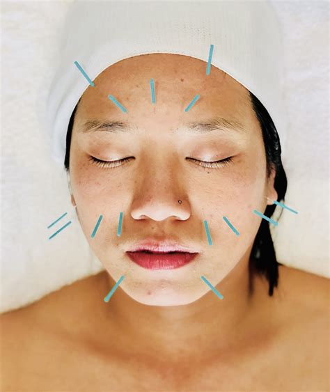 Cosmetic Facial Acupuncture - Kirsty Eng