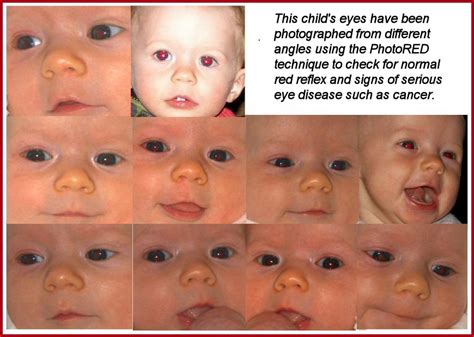 PhotoRED: Know the Glow and Check for Normal Fundal Reflex in Children ...