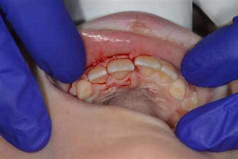 How to Reposition a Luxated (Displaced) Permanent Tooth — Kids Dental Tips