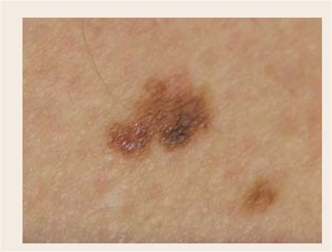 Melanoma Skin Cancer Survival Rate