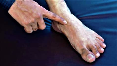 Navicular fracture causes, symptoms, diagnosis, treatment & prognosis