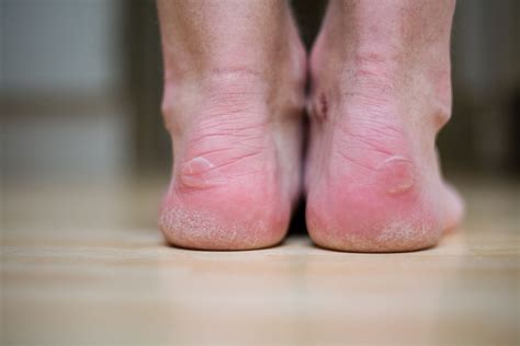 Blisters Care & Relief | Well Heeled Podiatry Hampton, Melbourne
