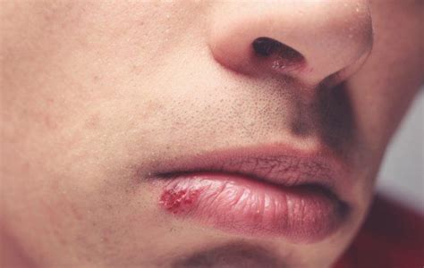 How to Detect, Prevent, and Treat Herpes | Men's Health