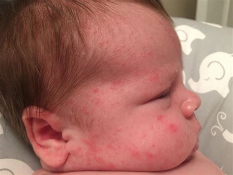 Is this newborn acne or a rash? It’s on both cheeks and his neck. I’m feeling paranoid because ...